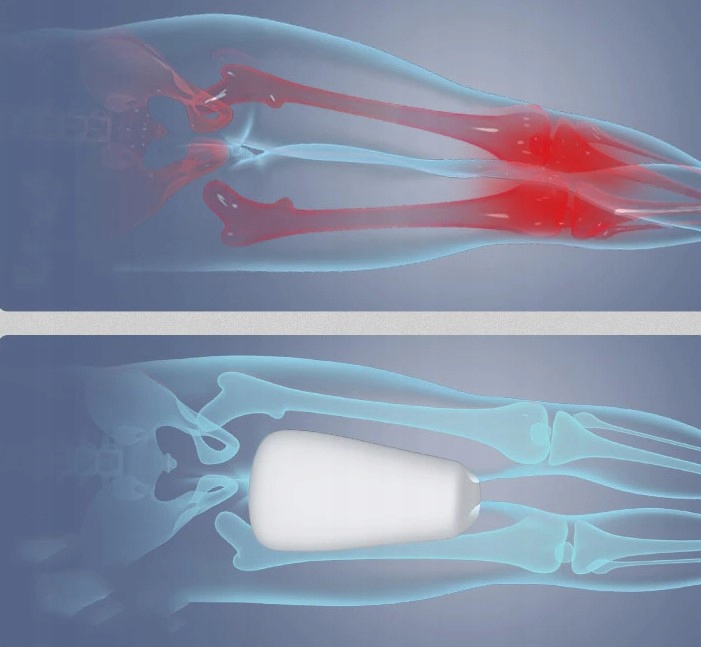 PODUSZKA ORTOPEDYCZNA KLIN MIĘDZY NOGI KOLANA DO SPANIA SEPARATOR MEMORY Długość 25 cm
