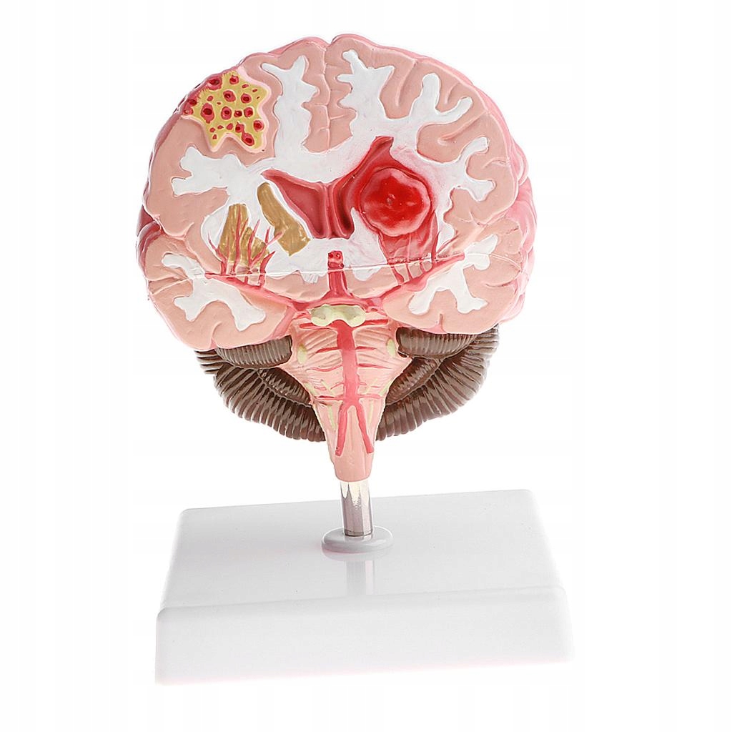Anatomiczny ludzki mózg patologiczny