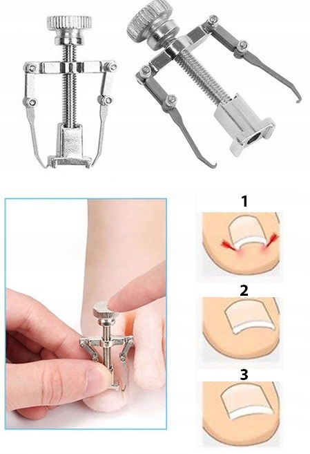 ZESTAW NA WRASTAJĄCE PAZNOKCIE KOREKCYJNY KLAMRA EAN (GTIN) 10470352119359