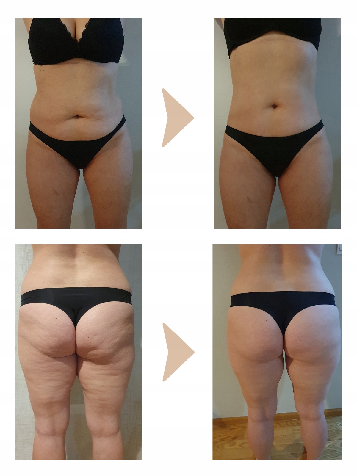 Zestaw na CELLULIT balsam do ciała + olejek do masażu + masażer BAŃKA Pojemność 200 ml