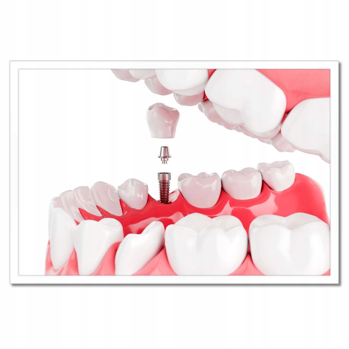 Plakáty v rámu 60x40 Zubní implantáty