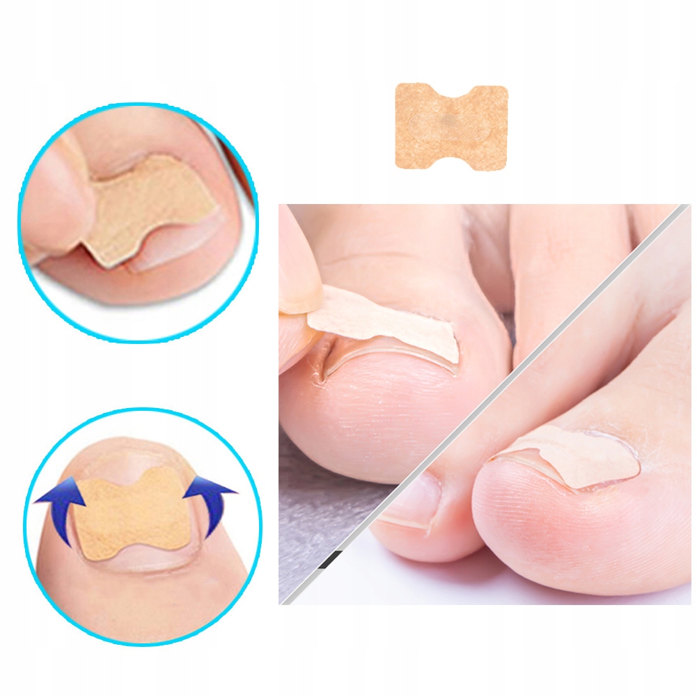 72X PASKI ŁATKI NA WRASTAJĄCE PAZNOKCIE PLASTRY Rodzaj inny