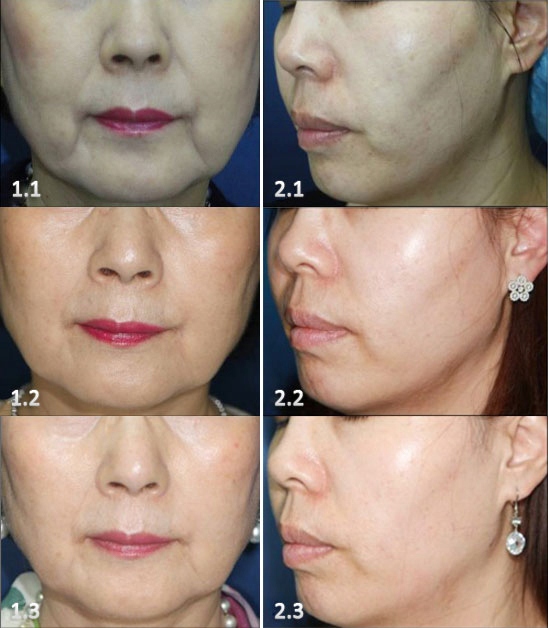 MINI HIFU ORYGINALNY ZMARSZCZKI BLIZNY FALE 3W1 Marka bez marki