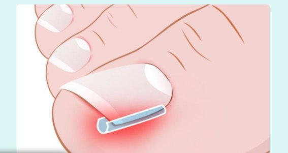 PASKI NA WRASTAJĄCE PAZNOKCIE KORYGUJĄCE ZAPOBIEGAJĄCE 10 SZT. Rodzaj pasek