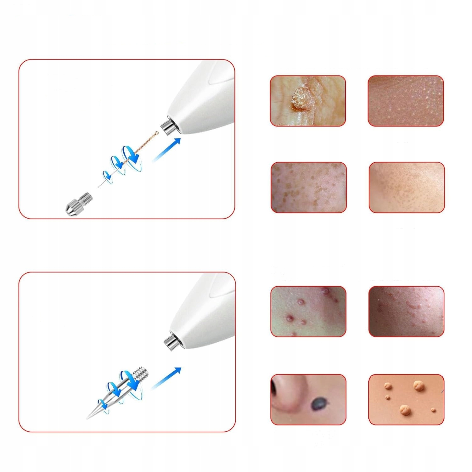 PLASMA PEN PLAZMA LASEROWE USUWANIE BLIZN TATUAŻY BRODAWEK PIEPRZYKÓW Model PLAZMA PEN