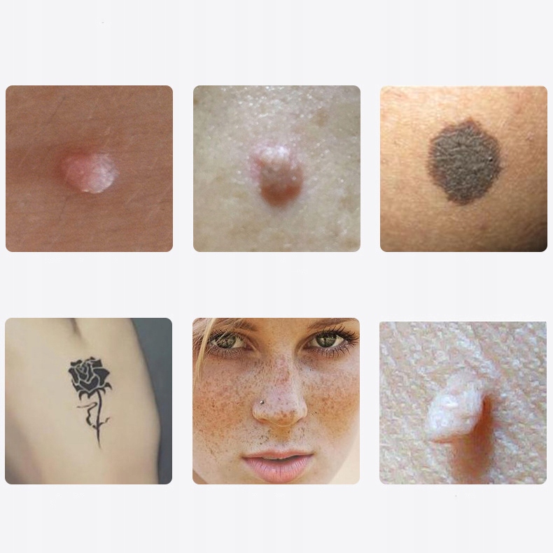 Plazma Pen Laser Spot Remover Plasma zapisuje Kretów Tatuaży Marka bez marki