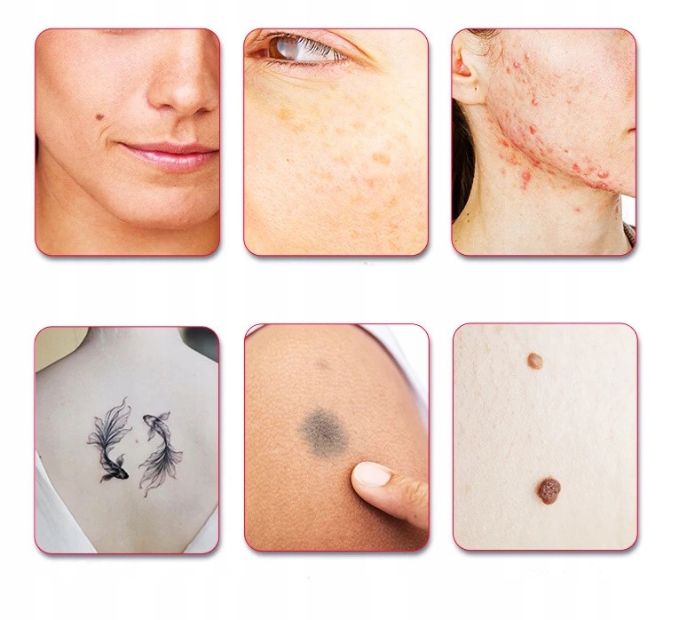 Laser Pikosekundowy Usuwanie Tatuażu Plam Znamion LESCOLTON Rodzaj inny