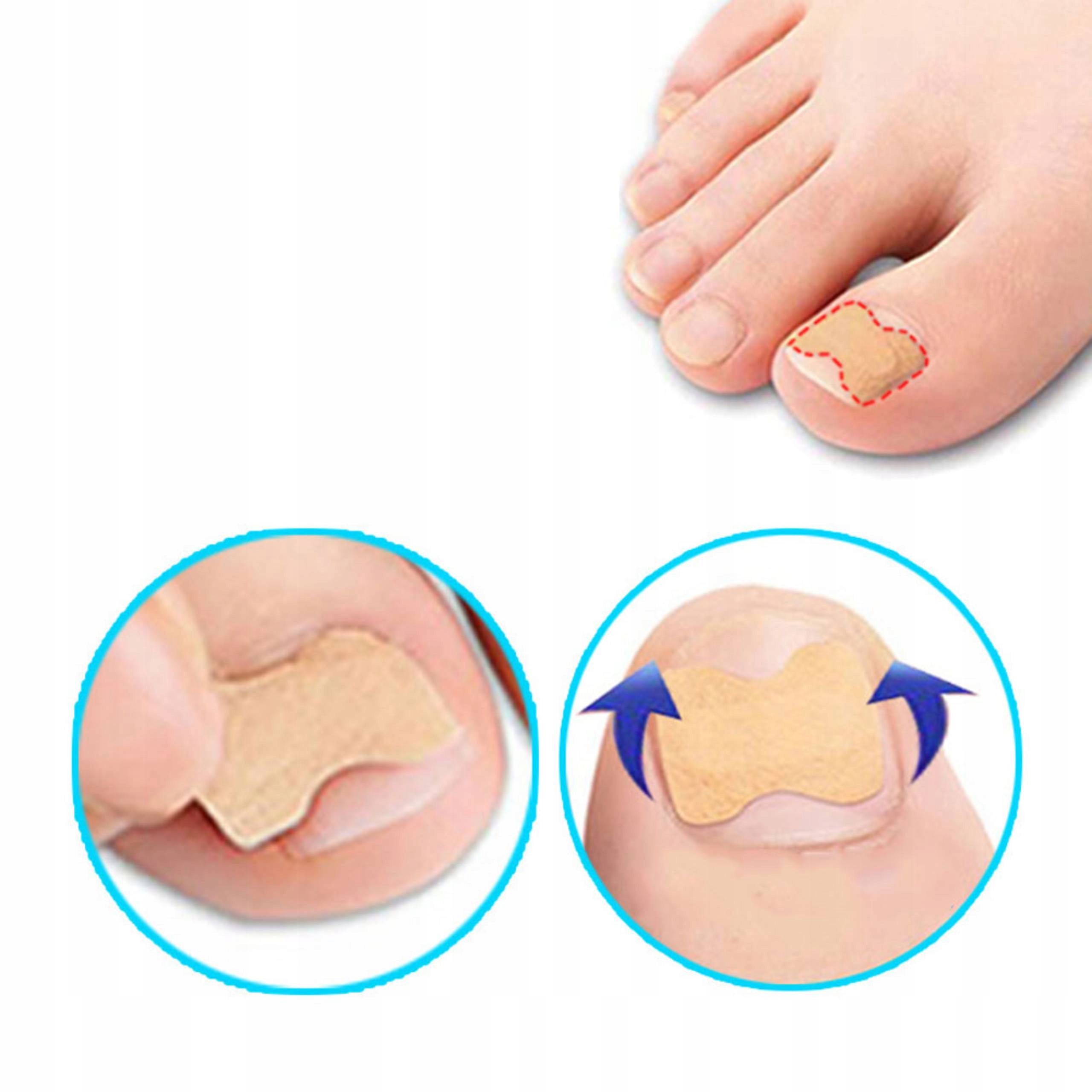 PASKI ŁATKI NA WRASTAJĄCE PAZNOKCIE PLASTRY 120SZT Stan opakowania oryginalne