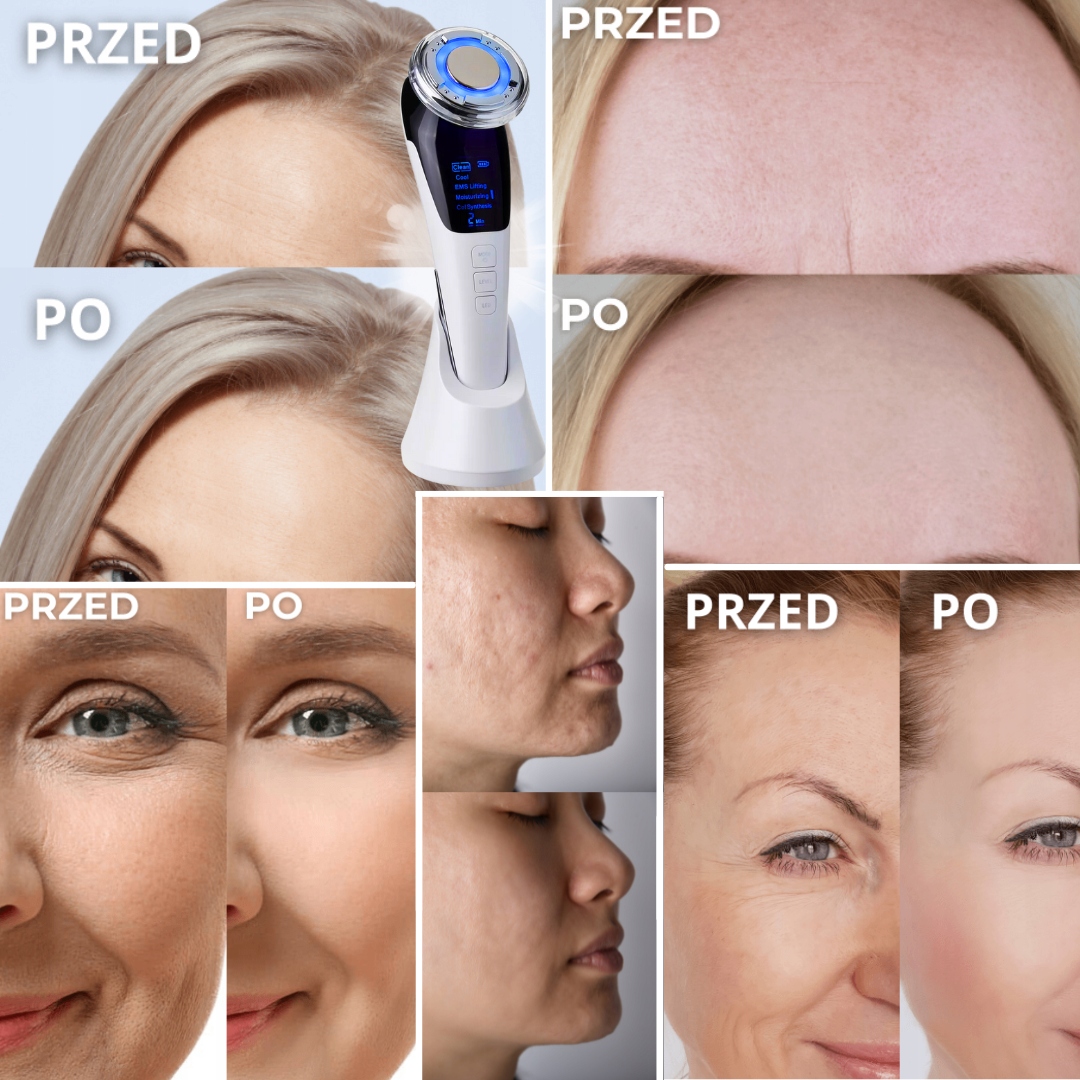 PREZENT DLA ŻONY NA WALENTYNKI MEZOTERAPIA BEZIGŁOWA MEZOPROSKIN DO TWARZY Zasilanie akumulatorowe