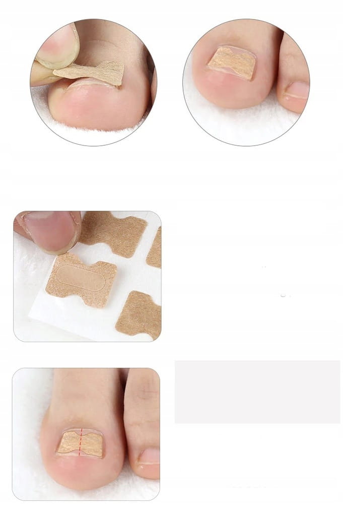 10 X PASKI NA WRASTAJĄCE PAZNOKCIE KLAMRA PLASTRY Rodzaj plaster