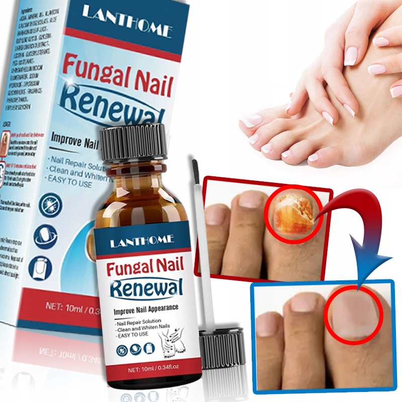 2X Plíseň na nehty Silný přípravek na opravu nehtů Lanthome 10 ml