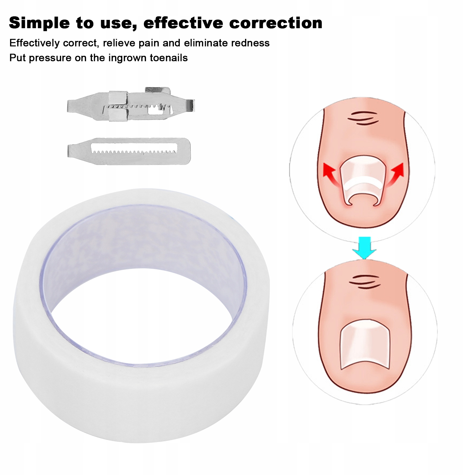 KLAMRA NA WRASTAJĄCE PAZNOKCIE ZESTAW Rodzaj inny