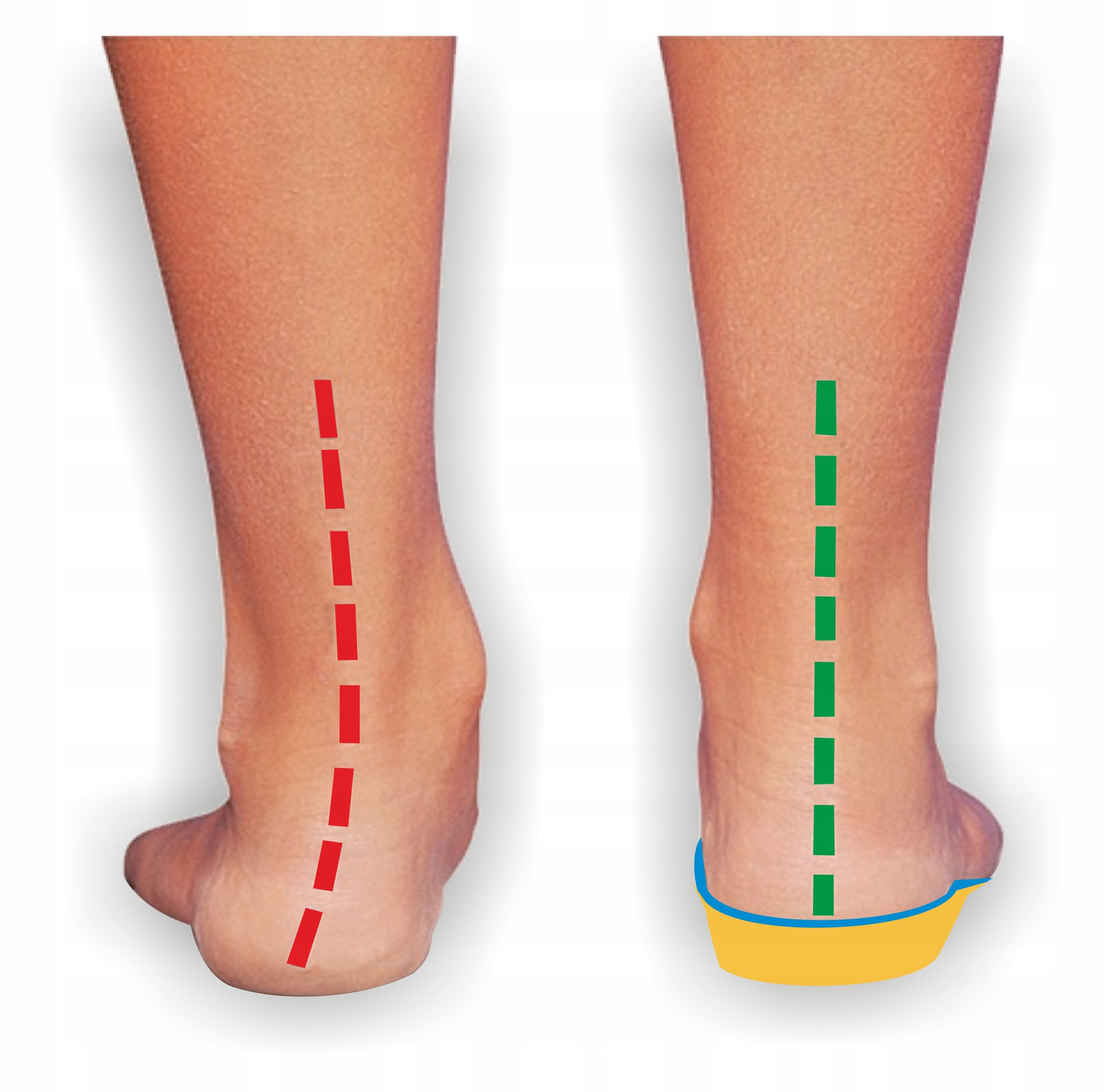 DZIECIĘCE WKŁADKI PROFILOWANE NA KOŚLAWOŚĆ STÓP PIĘT KOLAN SUPINUJĄCE 28/29 Marka Corbby