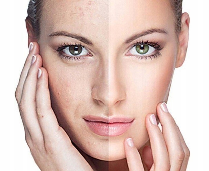 ODKURZACZ WĄGRÓW MIKRODERMABRAZJA DIAMENTOWA 4w1 Zasilanie bateryjne