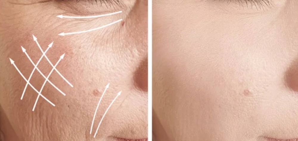 GLOVIS ROLLER 0.5mm GĘSTE WŁOSY ŁYSIENIE POROST Typ roller