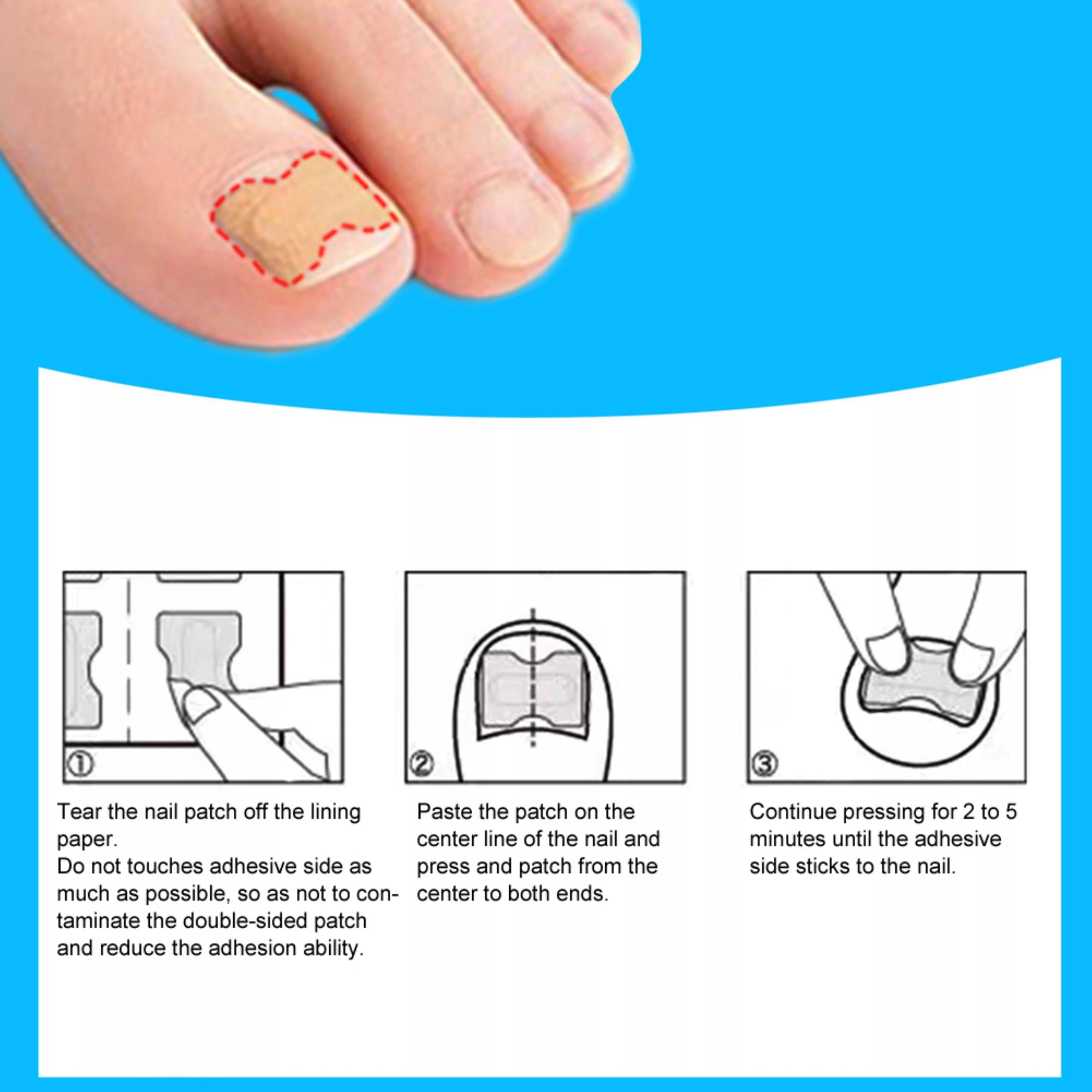 120 SZT PASKI PLASTRY ŁATKI NA WRASTAJĄCE PAZNOKCIE Rodzaj plaster