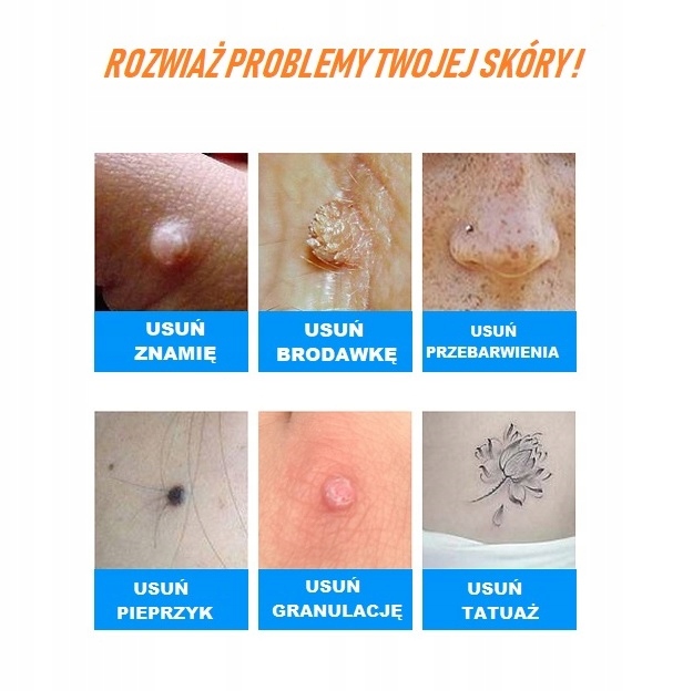 Plazma Kosmetyczna elektrokoagulacja Plasma Pen Rodzaj laser IPL