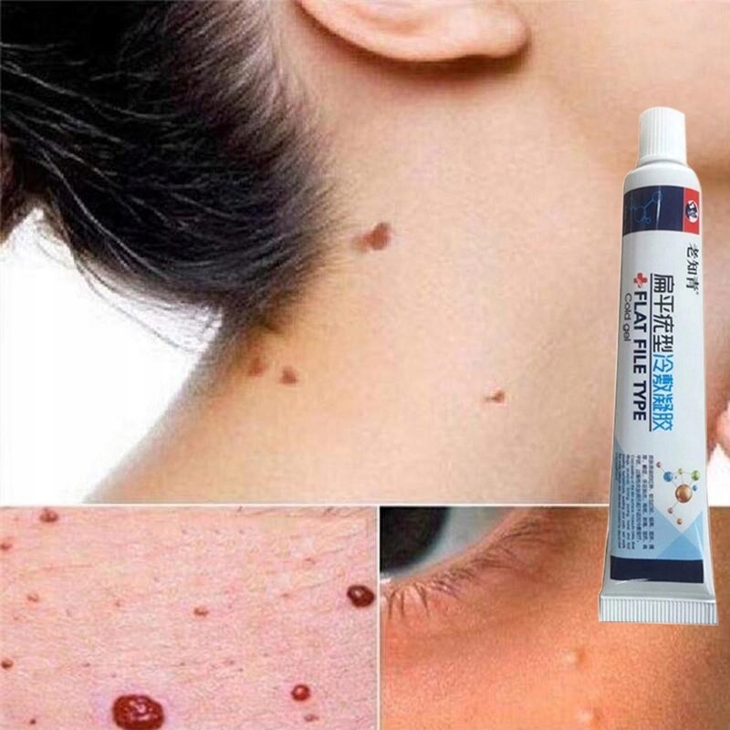 Maść Do Usuwania Kłykcin Sromu I Brodawek Marka Oneofthose