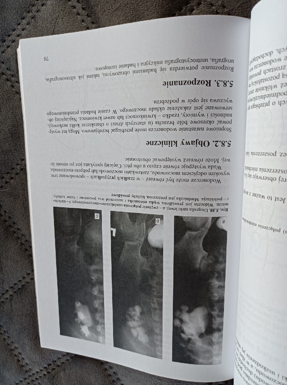 Pielektazja Nerek Co To Jest