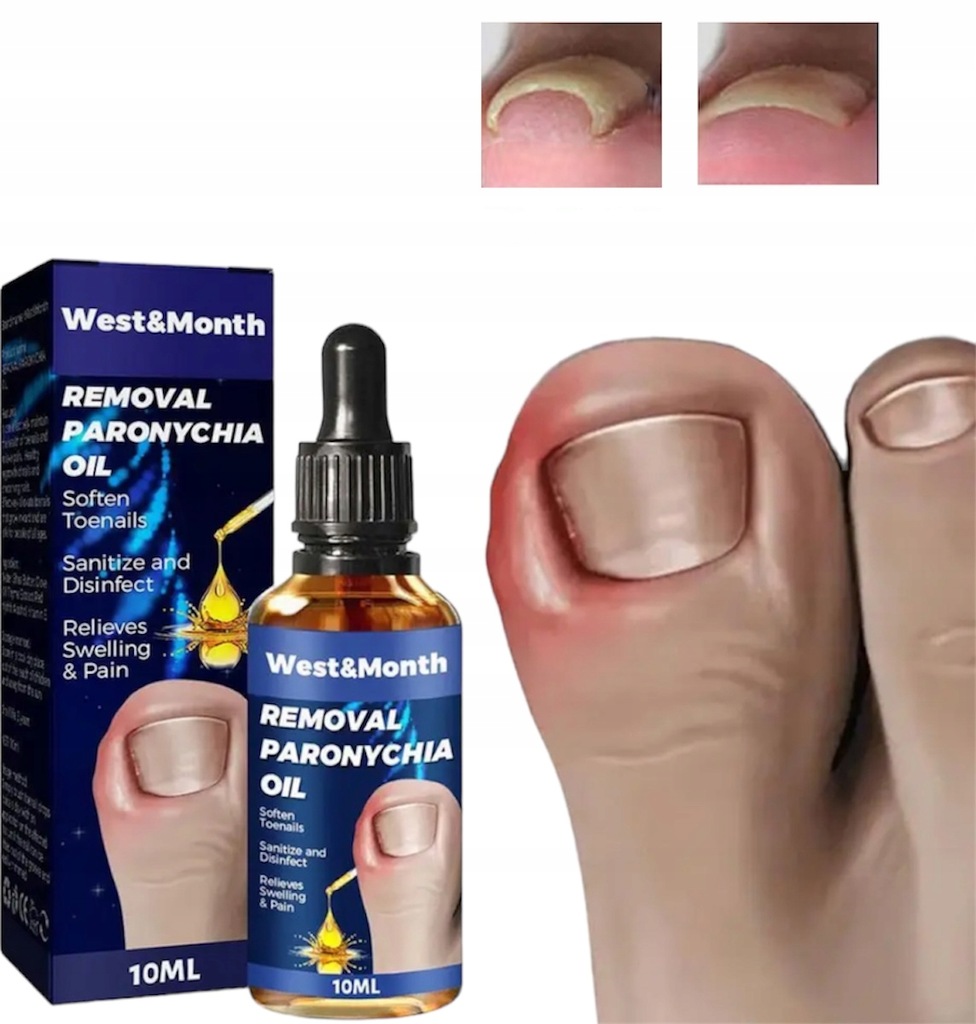 PŁYN NA WRASTAJĄCE PAZNOKCIE NA BÓL PAZNOKCIA 13882356595 oficjalne