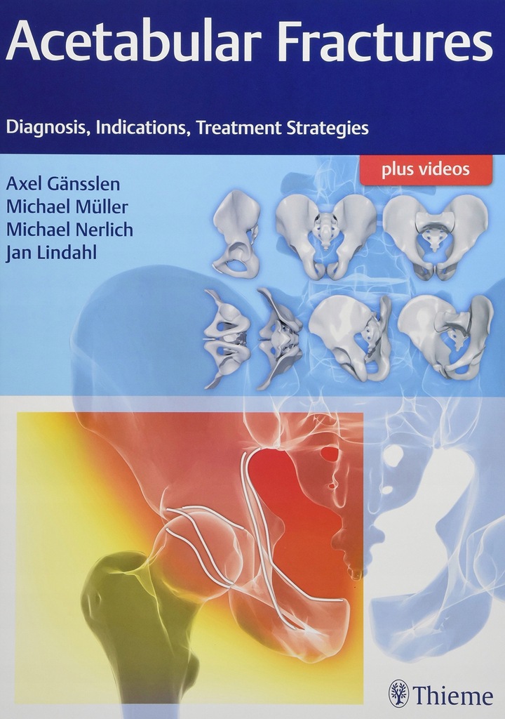 Acetabular Fractures