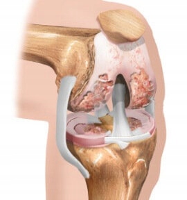 Durere persistentă în articulația șoldului drept - Numele bolii atunci când rănesc articulațiile