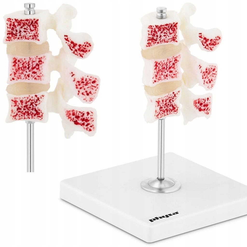 Model anatomiczny 3D osteoporozy lędźwiowej kręgi