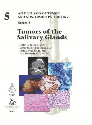 Tumors of the Salivary Glands