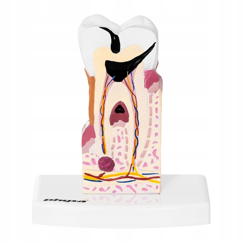 Model anatomiczny chorego zęba człowieka w skali