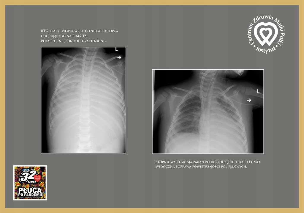 Obrazy RTG płuc Pacjenta po przechorowaniu Covid19