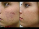 Revitol Scar Cream от старых шрамов и растяжек ШАНС!