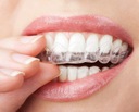 Литая каппа для релаксации нижних зубов при бруксизме