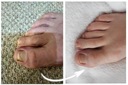 Spray na grzybicę paznokci stóp ze srebrem 100ml Rodzaj serum
