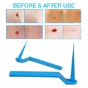 Набор для удаления меток кожи — 10 полосок