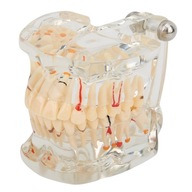 Priehľadná choroba Model zubov Implantát