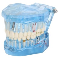 Verk 01964_N Model implantów dentystycznych n