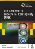 Pre-Descemet s Endothelial Keratoplasty (PDEK)