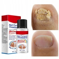 Körömgomba kezelés Care Essence