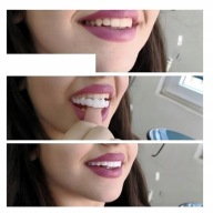 Oryginalne Licówki dentystyczne Snap on Smile 1 sztuka (zestaw góra i dół)