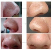 HIT2 x OCZYSZCZANIE NOSA TWARZY TRĄDZIK ZASKÓRNIKI