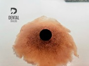 Proteza silikonowa piersi, sutka