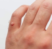 Preparat na kurzajki najlepszy 100% skuteczny