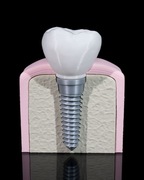 Model Stomatologiczny Implanta