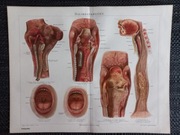 Choroby gardła - duża chromolitografia 1897 r.