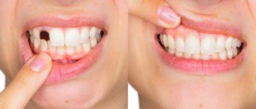 Зубные имплантаты Happy Smile Cosmetic