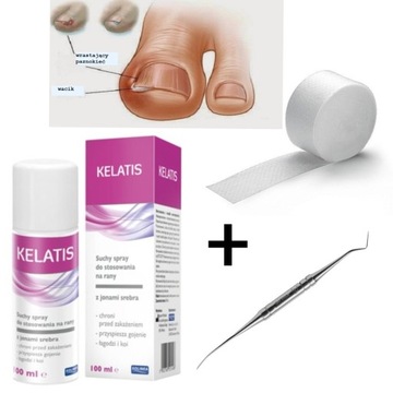 ВРАСТНЫЕ НОГТИ Зонд для тампонады Kelatis