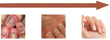 Грибок ногтей Strong Nail Repair Liquid JoyPretty 20мл