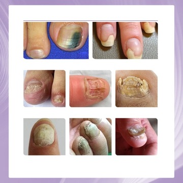 JAYSUING Nail Fungus 100 мл осветляющий спрей от грибка ногтей