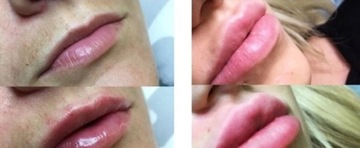 Безыгольное увеличение губ филлером HIALURON PEN