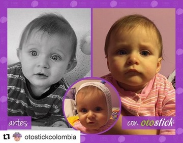 Перманентная коррекция PROJECTING EARS, OtoStick для детей